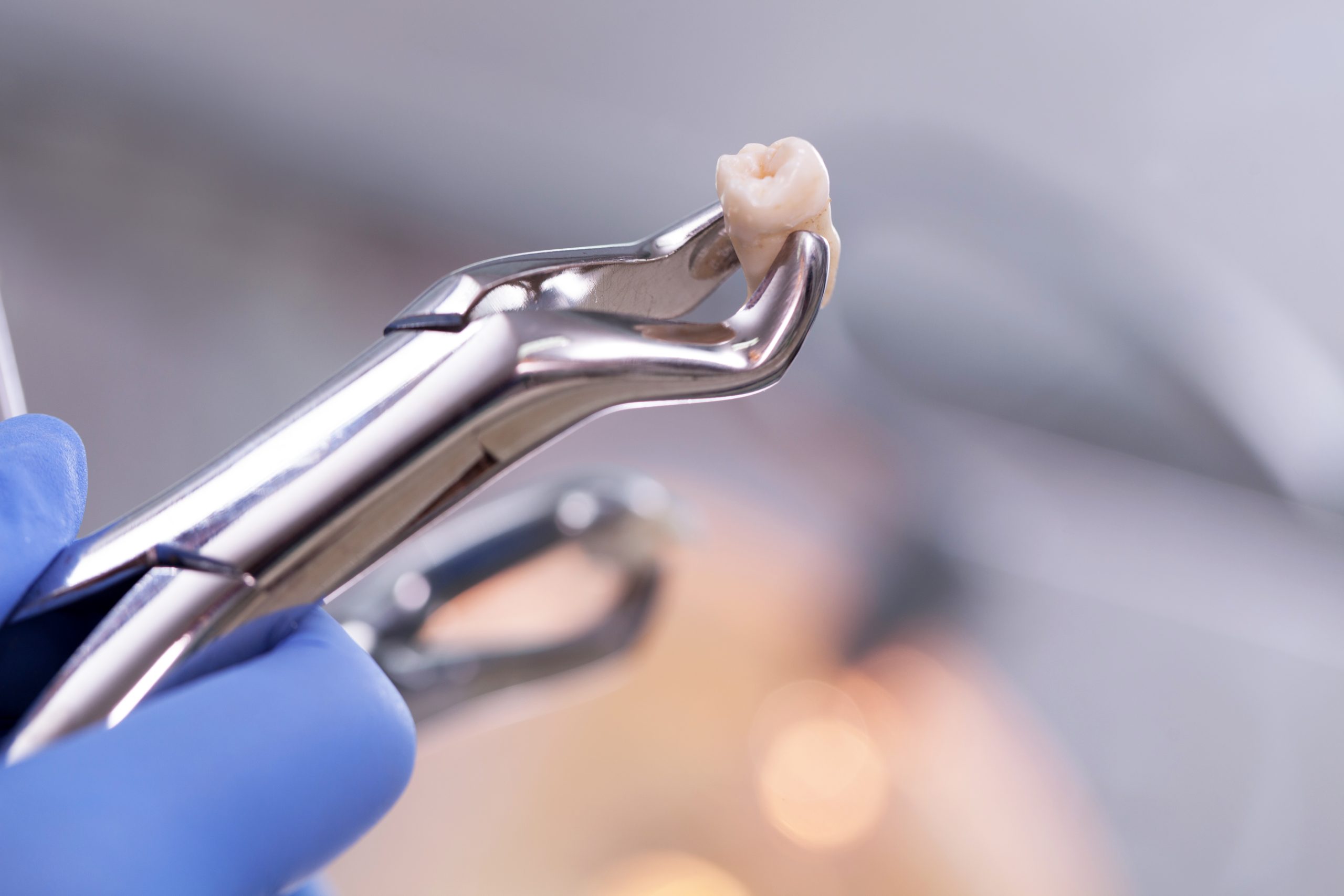 Tooth Extraction Recovery Tips Quick Healing